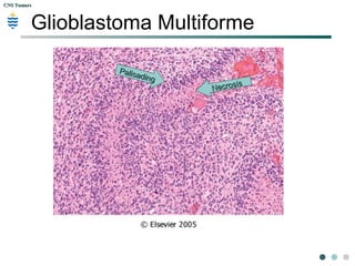CNS TumorsCNS Tumors
Glioblastoma Multiforme
Palisading
Palisading
Necrosis
Necrosis
 