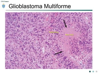 CNS TumorsCNS Tumors
Glioblastoma Multiforme
NecrosisNecrosis
PalisadingPalisading
 