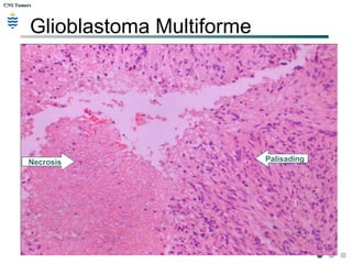 CNS TumorsCNS Tumors
Glioblastoma Multiforme
PalisadingNecrosis
 