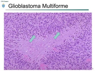 CNS TumorsCNS Tumors
Glioblastoma Multiforme
 