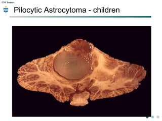 CNS TumorsCNS Tumors
Pilocytic Astrocytoma - children
 