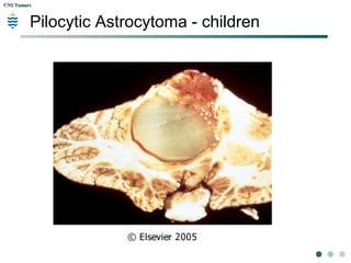 CNS TumorsCNS Tumors
Pilocytic Astrocytoma - children
 