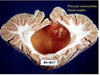 CNS TumorsCNS Tumors
Pilocytic astrocytoma
Mural nodule
 