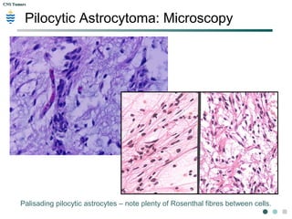 CNS TumorsCNS Tumors
Pilocytic Astrocytoma: Microscopy
Palisading pilocytic astrocytes – note plenty of Rosenthal fibres between cells.
 
