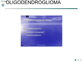 CNS TumorsCNS Tumors
OLIGODENDROGLIOMA
 
