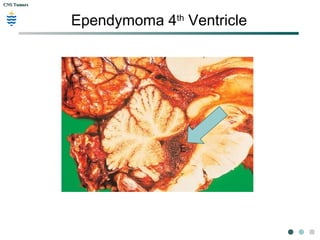 CNS TumorsCNS Tumors
Ependymoma 4th
Ventricle
 