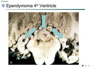CNS TumorsCNS Tumors
Ependymoma 4th
Ventricle
 
