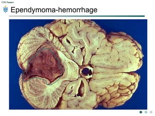 CNS TumorsCNS Tumors
Ependymoma-hemorrhage
 
