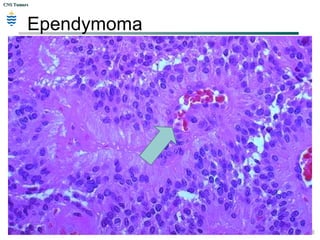 CNS TumorsCNS Tumors
Ependymoma
 