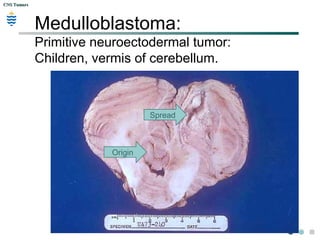 CNS TumorsCNS Tumors
Medulloblastoma:
Primitive neuroectodermal tumor:
Children, vermis of cerebellum.
Origin
Spread
 