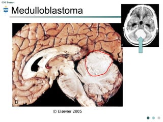 CNS TumorsCNS Tumors
Medulloblastoma
 