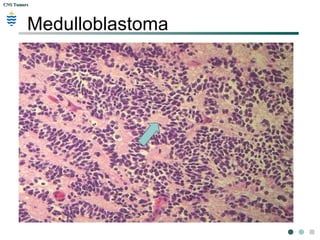 CNS TumorsCNS Tumors
Medulloblastoma
 