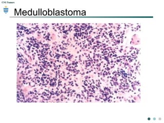 CNS TumorsCNS Tumors
Medulloblastoma
 