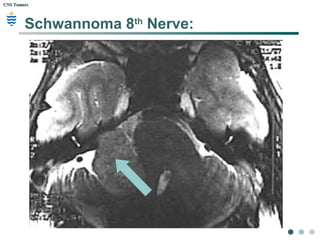 CNS TumorsCNS Tumors
Schwannoma / Neurofibroma
 