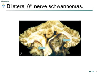 CNS TumorsCNS Tumors
Schwannoma 8th
Nerve:
 