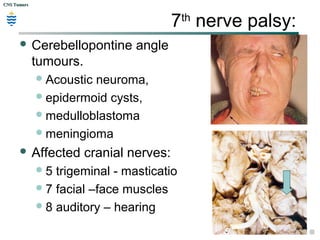 CNS TumorsCNS Tumors
7th
nerve palsy:
 Cerebellopontine angle
tumours.
Acoustic neuroma,
epidermoid cysts,
medulloblastoma
meningioma
 Affected cranial nerves:
5 trigeminal - masticatio
7 facial –face muscles
8 auditory – hearing
 