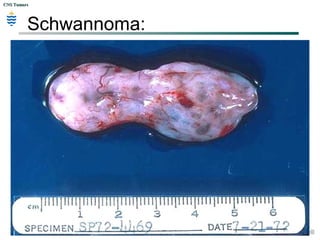 CNS TumorsCNS Tumors
Bilateral 8th
nerve schwannomas.
 