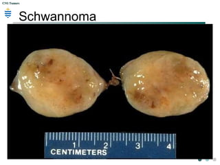 CNS TumorsCNS Tumors
Schwannoma:
 