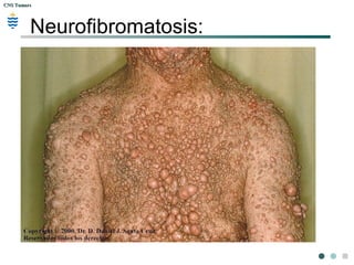 CNS TumorsCNS Tumors
Schwannoma
 