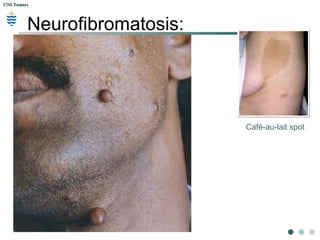 CNS TumorsCNS Tumors
Neurofibromatosis:
 