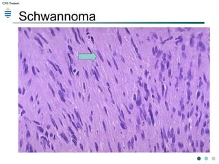 CNS TumorsCNS Tumors
Neurofibromatosis:
Café-au-lait spot
 