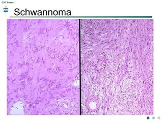 CNS TumorsCNS Tumors
Schwannoma
 