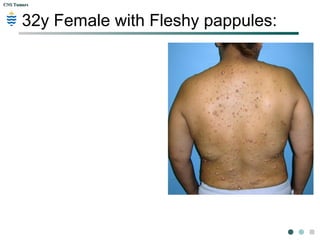 CNS TumorsCNS Tumors
Schwannoma
 