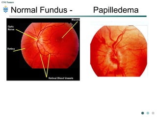 CNS TumorsCNS Tumors
Normal Fundus - Papilledema
 