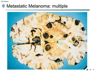 CNS TumorsCNS Tumors
METASTASES
common brain tumours in adults especially in
the elderly
 