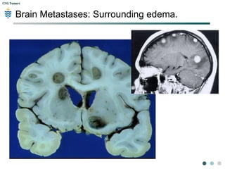CNS TumorsCNS Tumors
Metastatic Melanoma: multiple
 
