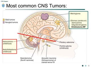 CNS TumorsCNS Tumors
Brain Metastases: Surrounding edema.
 