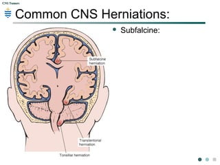 CNS TumorsCNS Tumors
Pathogenesis:
 Brain herniation: Supratentorial herniation common.
3 sub types
 Subfalcine herniation: The cingulate gyrus of the frontal
lobe (commonest)
 Central transtentorial herniation: displacement of the
basal nuclei and cerebral hemispheres downward
 Uncal herniation: Medial edge of the uncus and the
hippocampal gyrus
 Cerebellar herniation: infratentorial herniation -
tonsil of the cerebellum is pushed through the
foramen magnum and compresses the medulla,
leading to bradycardia and respiratory arrest.
 