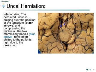 CNS TumorsCNS Tumors
Subfalcine Herniation: in brain trauma.
Contusion of the inferior temporal
lobe (blue arrow) has resulted in
diffuse edema. (compressed and
flattened gyri on the right).
This has resulted in subfalcine
herniation of the cingulate gyrus
(red arrow), with a secondary
hemorrhagic infarction above that
(black arrow). A midline shift from
right to left is also present, as is
uncal herniation (yellow arrow).
 