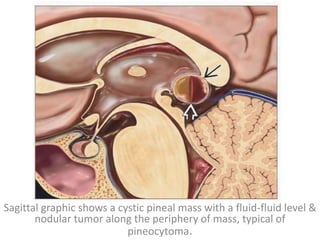 Sagittal graphic shows a cystic pineal mass with a fluid-fluid level &
nodular tumor along the periphery of mass, typical of
pineocytoma.
 