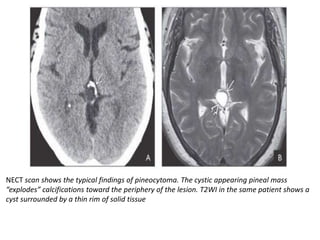 NECT scan shows the typical findings of pineocytoma. The cystic appearing pineal mass
“explodes” calcifications toward the periphery of the lesion. T2WI in the same patient shows a
cyst surrounded by a thin rim of solid tissue
 