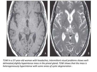 T1WI in a 57-year-old woman with headaches, intermittent visual problems shows well-
delineated,slightly hypointense mass in the pineal gland. T2WI shows that the mass is
heterogeneously hyperintense with some areas of cystic degeneration .
 