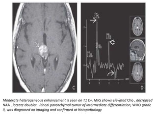 Moderate heterogeneous enhancement is seen on T1 C+. MRS shows elevated Cho , decreased
NAA , lactate doublet . Pineal parenchymal tumor of intermediate differentiation, WHO grade
II, was diagnosed on imaging and confirmed at histopathology
 