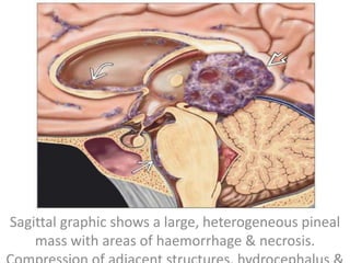 Sagittal graphic shows a large, heterogeneous pineal
mass with areas of haemorrhage & necrosis.
 
