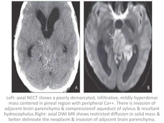 Left: axial NECT shows a poorly demarcated, infiltrative, mildly hyperdense
mass centered in pineal region with peripheral Ca++. There is invasion of
adjacent brain parenchyma & compressionof aqueduct of sylvius & resultant
hydrocephalus.Right: axial DWI MR shows restricted diffusion in solid mass &
better delineate the neoplasm & invasion of adjacent brain parenchyma.
 