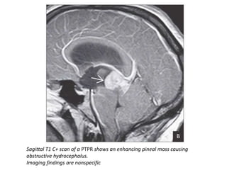 Sagittal T1 C+ scan of a PTPR shows an enhancing pineal mass causing
obstructive hydrocephalus.
Imaging findings are nonspecific
 