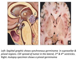 Left: Sagittal graphic shows synchronous germinoma in suprasellar &
pineal regions. CSF spread of tumor in the lateral, 3rd & 4th ventricles.
Right: Autopsy specimen shows a pineal germinoma
 