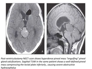 Post-ventriculostomy NECT scan shows hyperdense pineal mass “engulfing” pineal
gland calcifications. Sagittal T1WI in the same patient shows a well-defined pineal
mass compressing the tectal plate inferiorly , causing severe obstructive
hydrocephalus
 