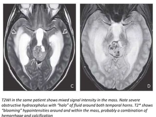 T2WI in the same patient shows mixed signal intensity in the mass. Note severe
obstructive hydrocephalus with “halo” of fluid around both temporal horns. T2* shows
“blooming” hypointensities around and within the mass, probably a combination of
hemorrhage and calcification
 