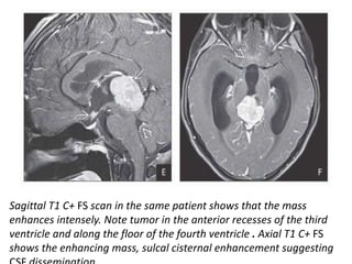 Sagittal T1 C+ FS scan in the same patient shows that the mass
enhances intensely. Note tumor in the anterior recesses of the third
ventricle and along the floor of the fourth ventricle . Axial T1 C+ FS
shows the enhancing mass, sulcal cisternal enhancement suggesting
 