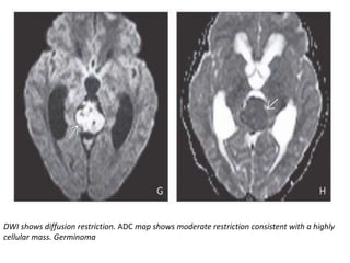 DWI shows diffusion restriction. ADC map shows moderate restriction consistent with a highly
cellular mass. Germinoma
 