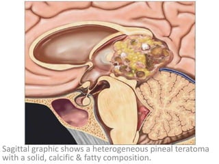 Sagittal graphic shows a heterogeneous pineal teratoma
with a solid, calcific & fatty composition.
 
