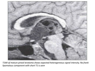 T1WI of mature pineal teratoma shows expected heterogeneous signal intensity. No frank
lipomatous component with short T1 is seen
 