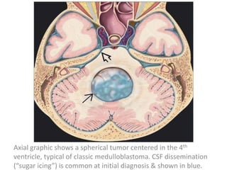 Axial graphic shows a spherical tumor centered in the 4th
ventricle, typical of classic medulloblastoma. CSF dissemination
(“sugar icing”) is common at initial diagnosis & shown in blue.
 