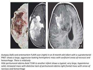 Autopsy (left) and antemortem FLAIR scan (right) in an 8-month-old infant with a supratentorial
PNET shows a large, aggressive-looking hemispheric mass with confluent areas of necrosis and
hemorrhage. There is relatively
little peritumoral edema.Axial T1WI in another infant shows a typical, very large, hypointense
solid, intraaxial mass with distictive lack of peritumoral edema right frontal mass with areas of
necrosis and hemorrhage
 