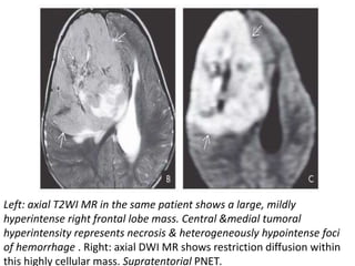 Left: axial T2WI MR in the same patient shows a large, mildly
hyperintense right frontal lobe mass. Central &medial tumoral
hyperintensity represents necrosis & heterogeneously hypointense foci
of hemorrhage . Right: axial DWI MR shows restriction diffusion within
this highly cellular mass. Supratentorial PNET.
 